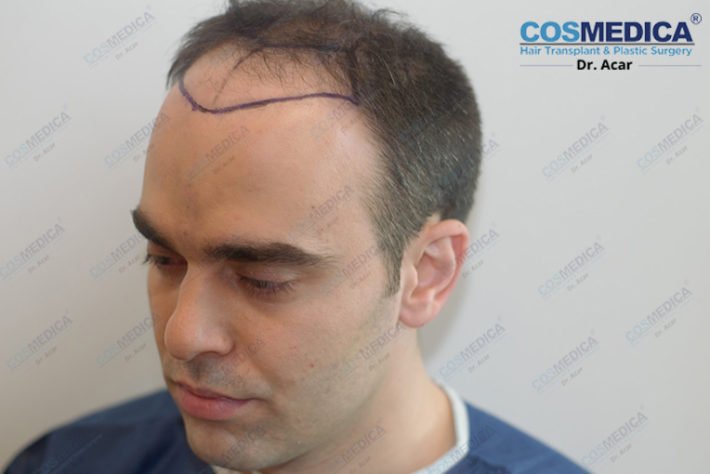 Haartransplantation In Der Turkei Istanbul Dr Acar 4 Dr Acar