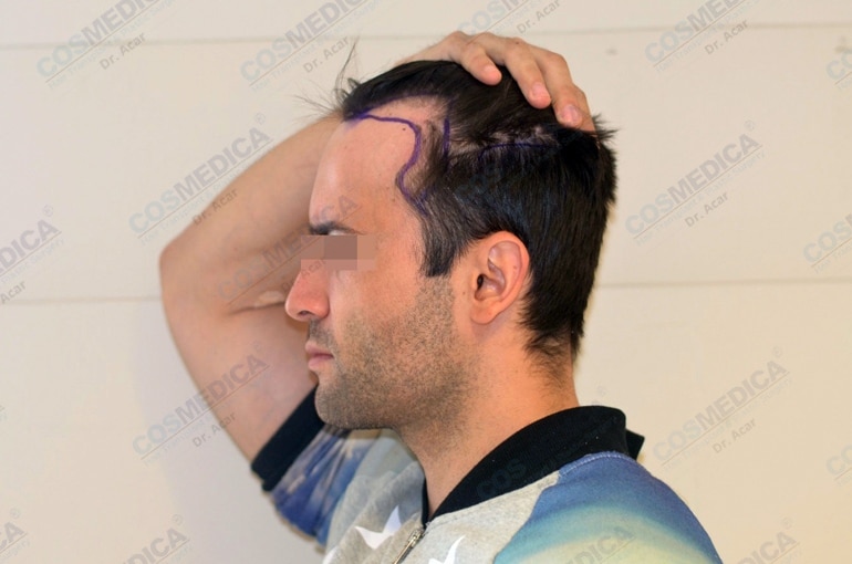 Haartransplantation In Der T Rkei Istanbul Klinik Dr Acar