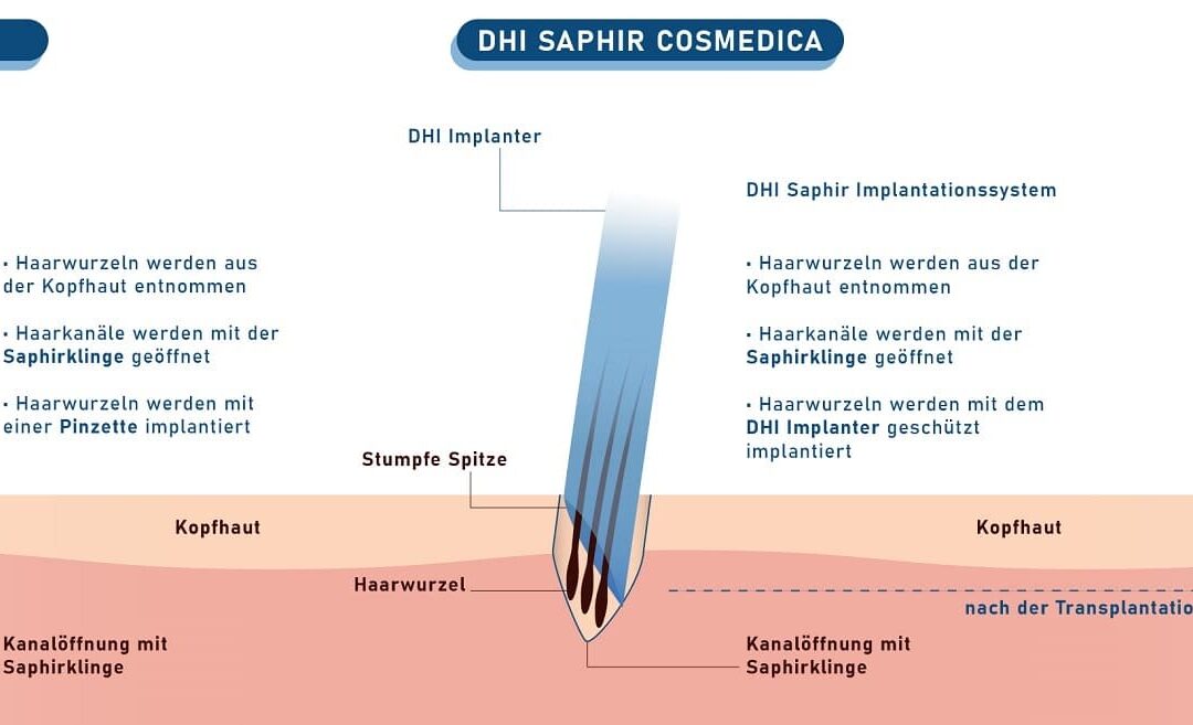 Saphir Techniken Dr Acar