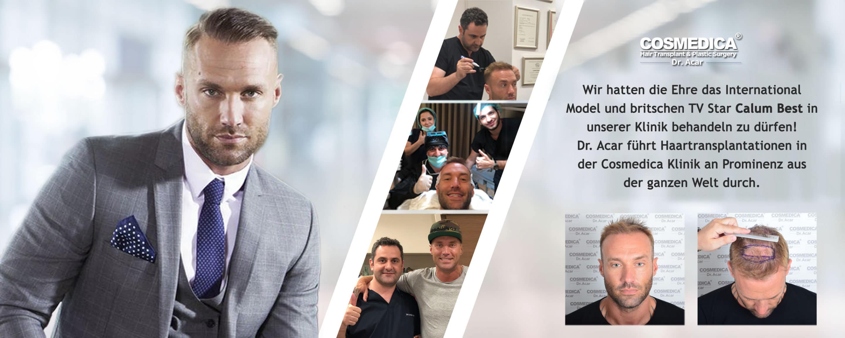 calum-best-haartransplantation-in-der-türkei-istanbul-dr-acar