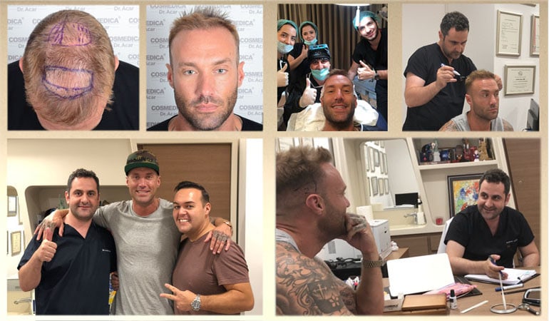 haartransplantation-calum-best-tv-star-in-der-türkei-und-istanbul