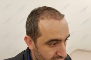 haartransplantation-in-der-turkei-istanbul-haar (3)
