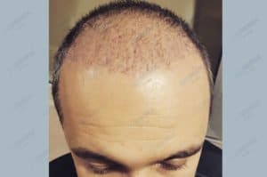 haartransplantation-in-der-turkei-istanbul-haar (9)