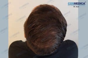 haartransplantation-in-der-türkei-haar-transplantation (9)