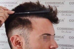 haartransplantation-in-der-türkei-istanbul-klinik (5)