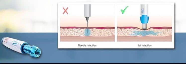 Nadellose Betäubung - Haartransplantation Cosmedica