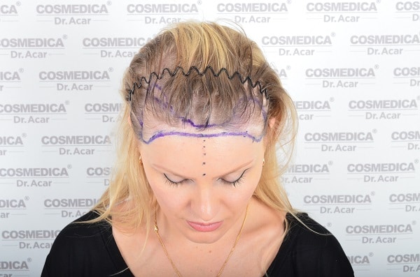 Haartransplantation Bei Frauen Dr Acar