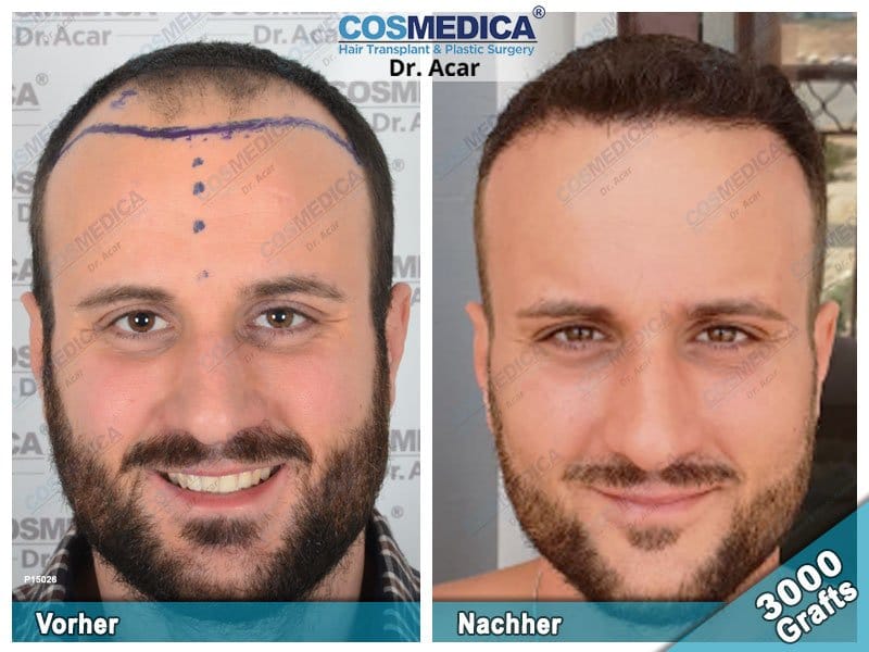 Haartransplantation Türkei Vorher Nachher 11 Dr Acar