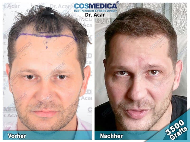 Ergebnis nach einer Haartransplantation mit 3500 Grafts