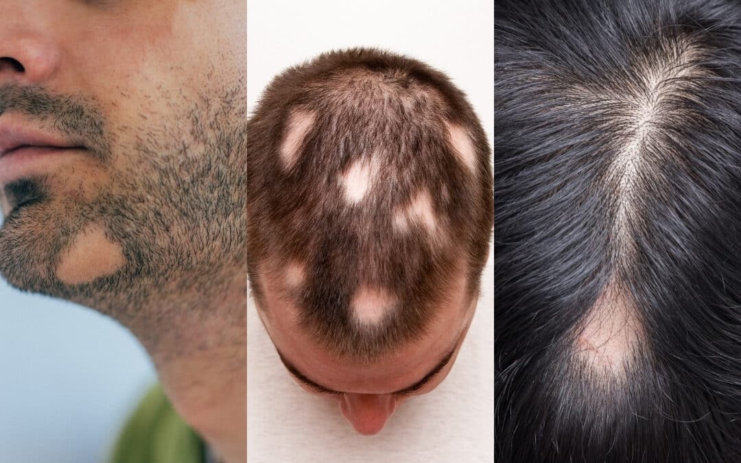 Alopecia Areata – Kreisrunder Haarausfall
