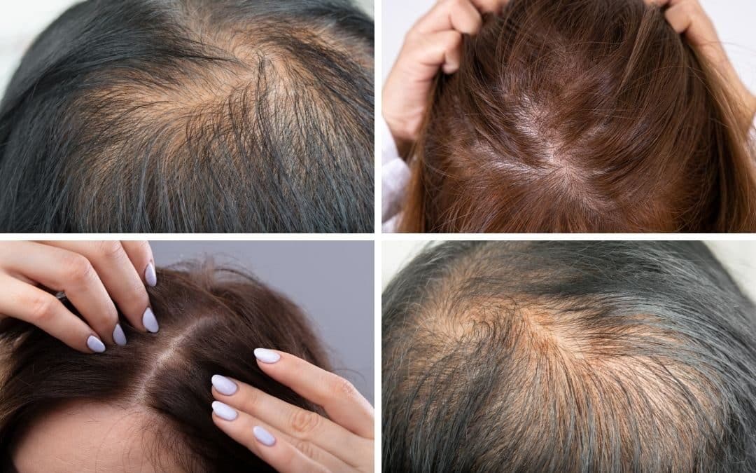 Diffuser Haarausfall – wenn Haare dünner werden