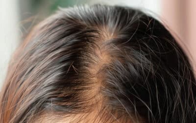 Diffuser Haarausfall – wenn Haare dünner werden