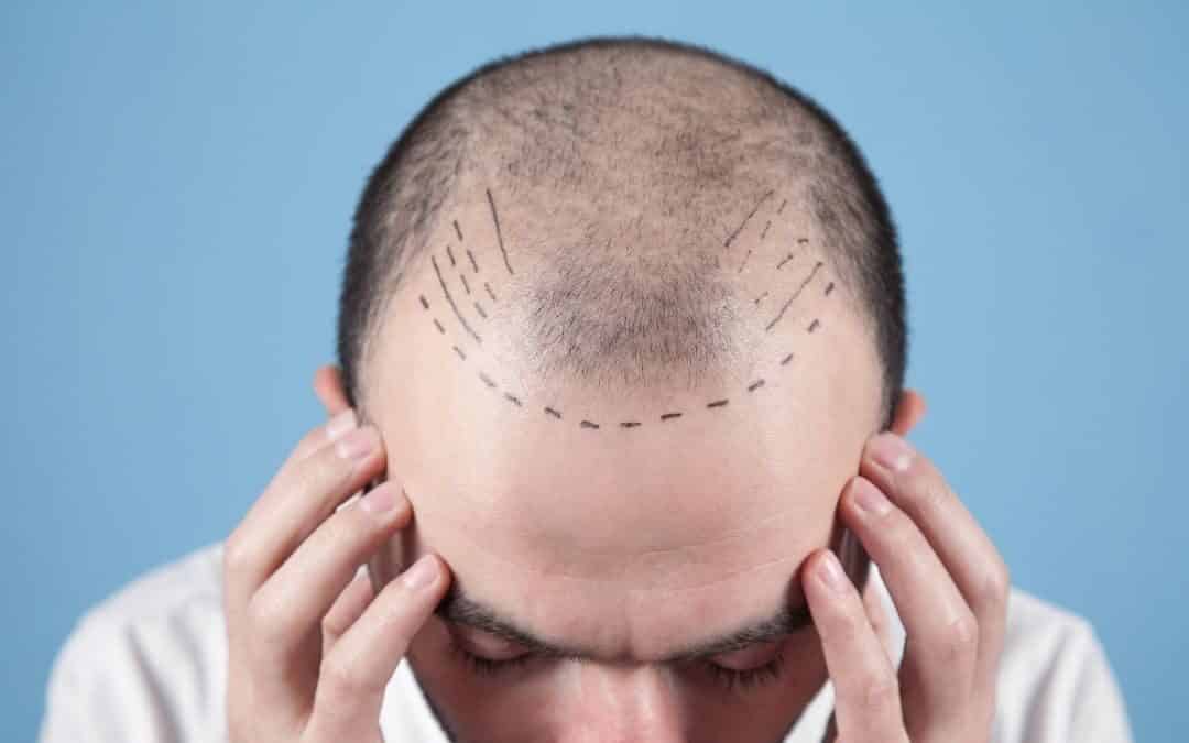 Haartransplantation: Schmerzen können größtenteils vermieden werden