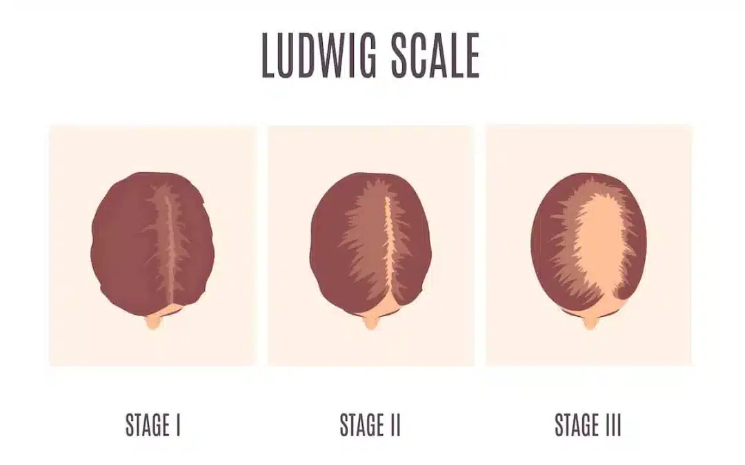 Ludwig-Skala: Klassifizierung der weiblichen Glatzenbildung  