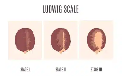 Ludwig-Skala zur Klassifizierung des weiblichen Haarausfalls mit den drei Stadien