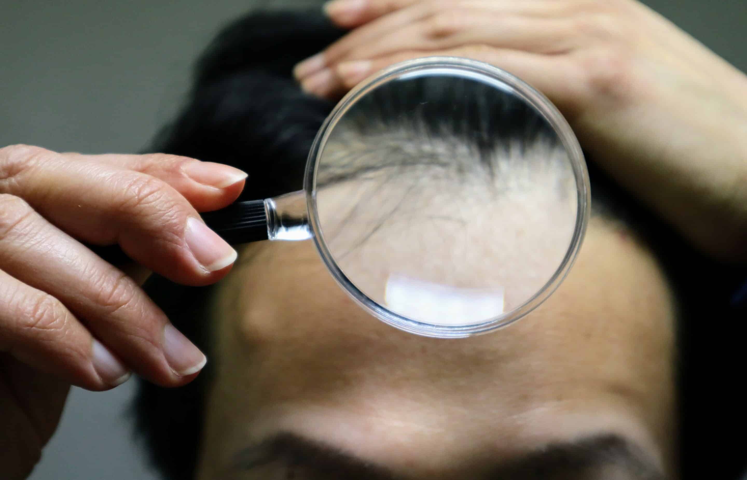 Androgenetischer Haarausfall Gründe