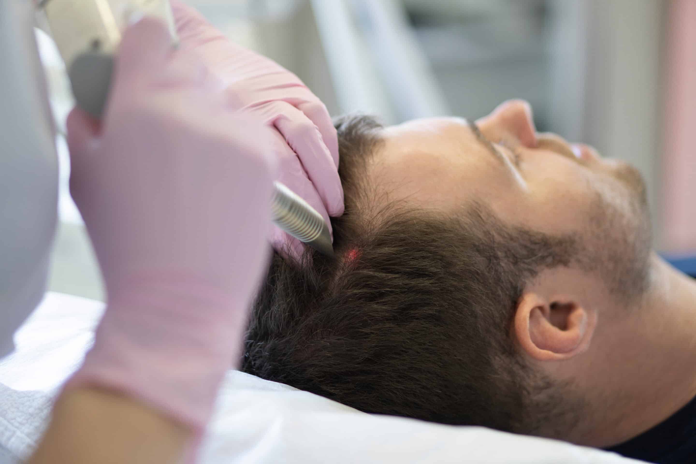 Stammzellen bei der Haartransplantation fördern Haarwachstum