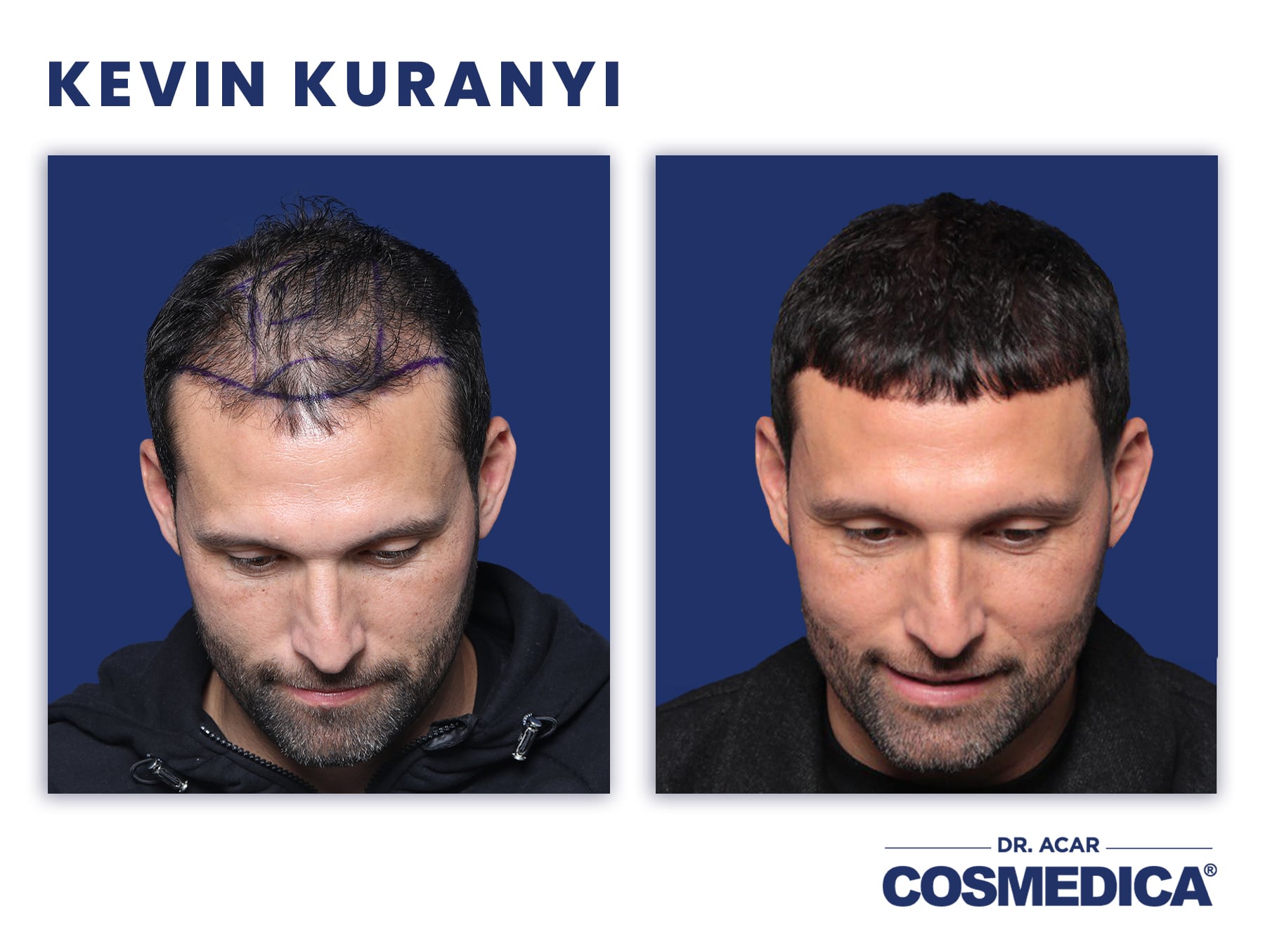 Kevin Kuranyi vorher nacher Haartransplantation Cosmedica