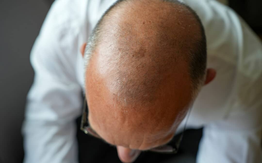 Haartransplantation bei Halbglatze: Was ist möglich?